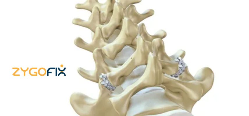 ZygoFix’s Zlock Lumbar Facet Fixation System Receives US FDA Clearance